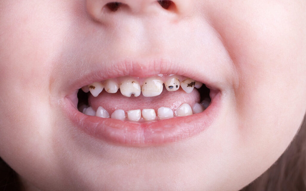 Understanding Baby Bottle Tooth Decay