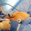 Exploring Bariatric Surgery