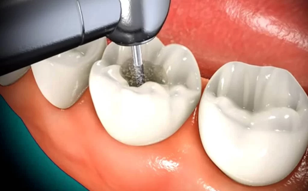 Does Delaying Root Canal Treatment Have Any Consequences?