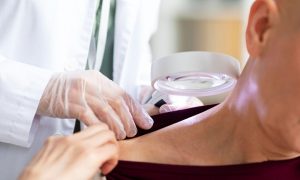When Laser Mole Removal Is Appropriate—And When It Is Not